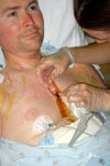Kyle goes through an incision dressing change 60 hours after his transplant. Photo provided by Kyle Garlett. Kyle goes through an incision dressing change 60 hours after his transplant. Photo provided by Kyle Garlett.