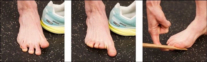 shin splints