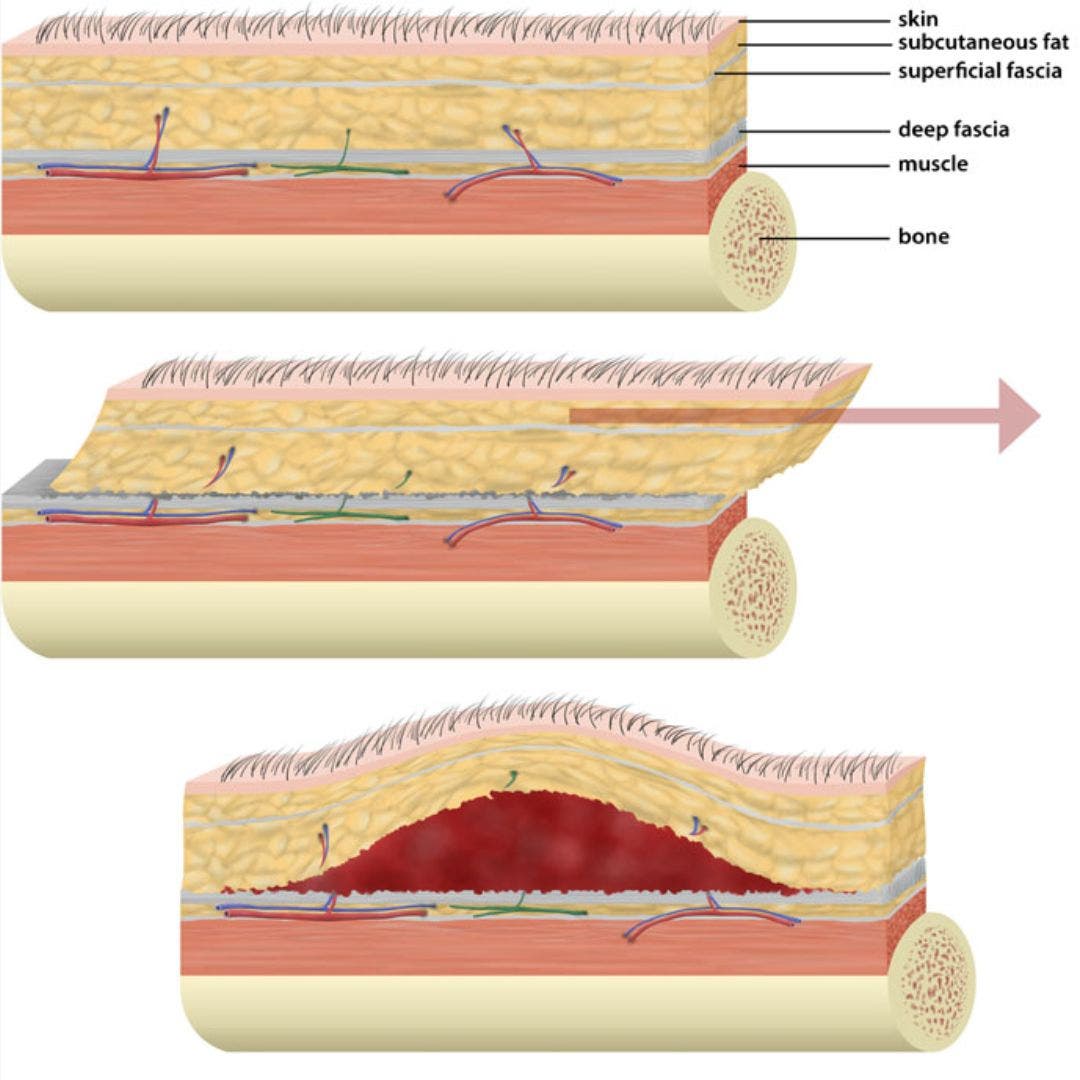 A medical diagram of a Morel-Lavallée lesion, Jan Frodeno's injury