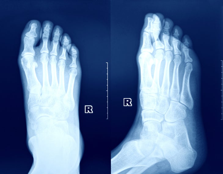 An x-ray of a foot to self-diagnose a stress fracture